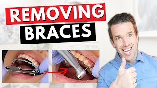 Removing Braces  How We Take Off Braces  Dr Nate [upl. by Ledba642]