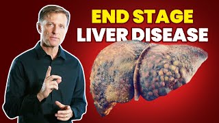 10 Signs of a Dying Liver End Stage Liver Disease [upl. by Wyly835]