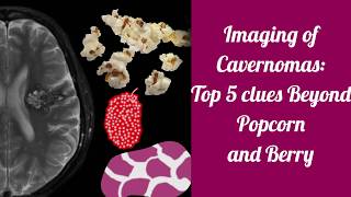 Imaging of cavernomas  Beyond Popcorn and Berry [upl. by Loresz672]