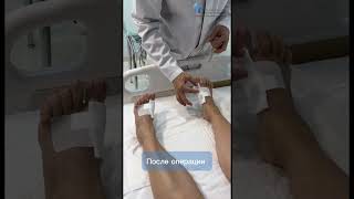 Лечение HALLUX VALGUS шишка на ногах вальгус плоскостопие здоровье здоровыйобразжизни хирург [upl. by Freida993]