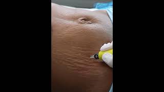 Stretch Marks Inkless Removal Boleyn Treatment Los Angeles 🌍 shorts [upl. by Anelet]