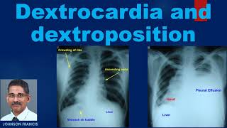 Dextrocardia and Dextroposition [upl. by Voletta59]