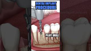 DENTAL IMPLANT 🦷 dentist trending dentisty viralvideo [upl. by Dian682]