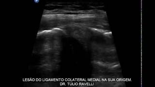 ULTRASSOM DO JOELHO  LESÃO DO LIGAMENTO COLATERAL MEDIAL [upl. by Asela]