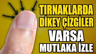 Tırnaklarda Çizgiler Oluşmasının Nedeni ve Evde Nasıl Tadavi Edilir  Tırnak Sağlığı İçin Bunu Yap [upl. by Eicyak54]