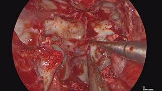 Endoscopic Endonasal Approach for Craniopharyngioma Resection with Nasoseptal Flap Reconstruction [upl. by Immanuel]