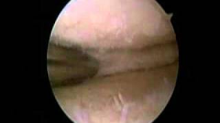 Knee arthroscopy meniscus tear with arthritis [upl. by Pulling]