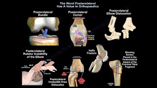 Posterolateral ACL bundle posterolateral corner Everything You Need To Know  Dr Nabil Ebraheim [upl. by Mutz]