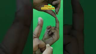 Mallet finger physiotherapy joints nerve pain anatomy stiffness movement dip pip mcp ruhs [upl. by Yrrej]