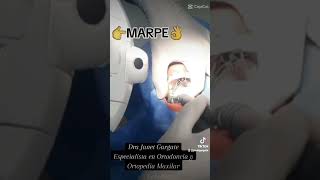 Disyunción Maxilar en Adultos MARPE dentist orthodontist ortodoncia [upl. by Noissap]