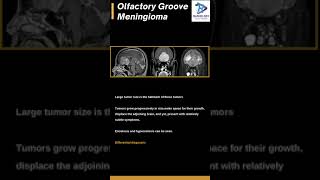 Olfactory groove meningiomaMeningiomaExtraaxial tumor [upl. by Huston]