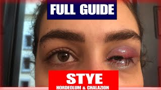 Hordeolum vs Chalazion A COMPLETE GUIDE CONVENTIONAL AND HOME REMEDIES [upl. by Enois]