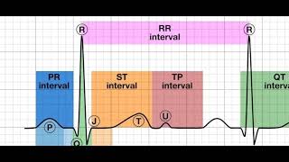 myocardial infarction stemi and nstemi [upl. by Cranford]