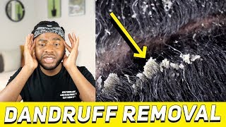 REACTING TO EXTREME DANDRUFF SCRATCHING AND REMOVAL and tips for dry flakey scalp [upl. by Asyl]