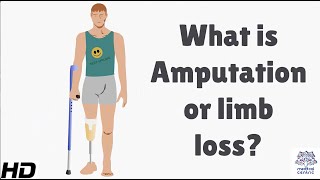 What is Amputation or Limb Loss [upl. by Keyek219]