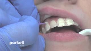 Bonding Worn Anterior Teeth  Dental Minute with Dr Steven T Cutbirth DDS [upl. by Moriarty]