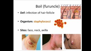 Boil furuncle [upl. by Louisette]