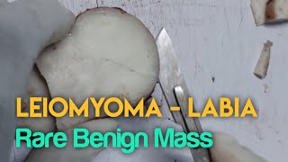 Leiomyoma  Labia Rare Benign Mass  Dissection essenceworld [upl. by Elbart782]