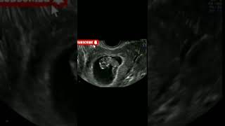 ultrasound Scan during pregnancy youtubeshorts ytshorts viral pregnancy [upl. by Elena]