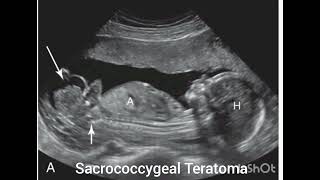 Ultrasound of Sacrococcygeal Teratoma Review from the book Requisites of Ultrasound [upl. by Skricki]