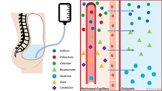 Peritoneal Dialysis [upl. by Nepil127]