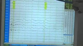 EEG  Die Elektroenzephalografie [upl. by Aseram641]