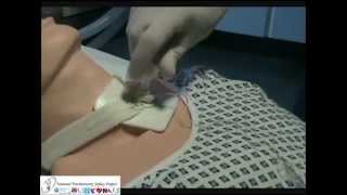 Removal of Tracheostomy Speaking Valves and Inner Tubes [upl. by Nerfe]