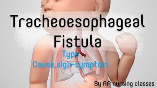 Tracheoesophageal Fistula TEF cause signsymptom childhealthnursing bscnursing 5thsem24 [upl. by Araldo]