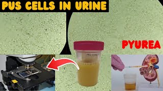 Pus cells in Urine  UTI  Urine complete examination urineanalysis [upl. by Gibrian]