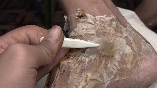 How to removal skin  callus removal skin flakes 08 [upl. by Shaylah]