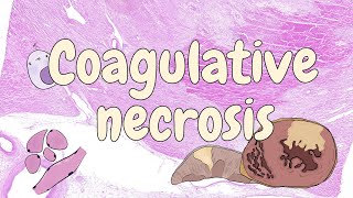 Coagulative necrosis  general pathology [upl. by Deaner]