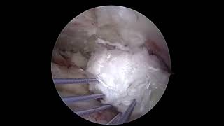 Lower Trapezius Transfer with Partial Cuff Repair [upl. by Allimak]