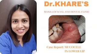 Mucocele case report [upl. by Atileda421]