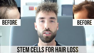 STEM CELL Hair Restoration Patient Testimonial [upl. by Sefton]