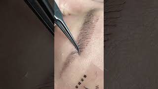 eyebrow transplantation eyebrows sopracciglio sobrancrlhas cejas sourcils hairtransplantation [upl. by Kienan]