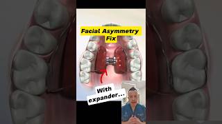 Fixing Facial Asymmetry with a Palate Expander Heres How dentallan dentist shorts [upl. by Opaline]