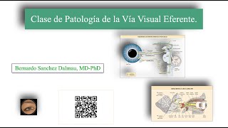 Clase de Patología de la Vía Visual Eferente [upl. by Leor211]