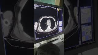 Distended small bowel loops related to ventral hernia which shows small bowel contents [upl. by Summer]