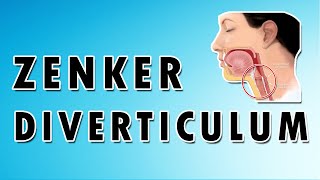 Zenkers Diverticulum [upl. by Gherlein]