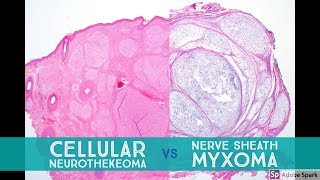 Cellular Neurothekeoma vs Nerve Sheath Myxoma  Dermpath Lookalikes [upl. by Doretta]