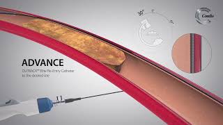 OUTBACK™ Elite ReEntry Catheter Product Highlights [upl. by Valer]