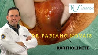 CIRURGIA DA GLANDULA DE BARTHOLIN O QUE VOCE PRECISA SABER ANTES DE FAZER [upl. by Kenneth]