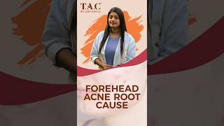 Reasons for Forehead Acne  Acne [upl. by Arther556]