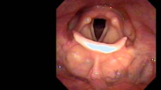 Normal laryngoscopy [upl. by Ritch]