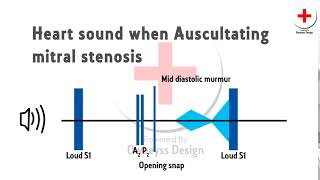 heart sound  Mitral stenosis [upl. by Parrott804]