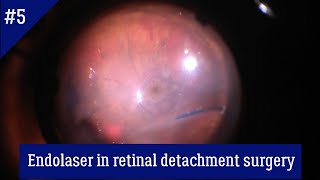 Endolaser in retinal detachment surgery [upl. by Ateerys]