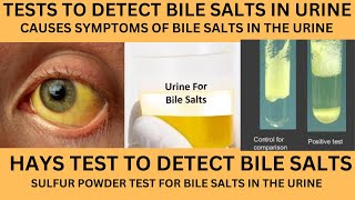 BILE SALTS IN URINEHAYS TEST TO DETECT BILE SALTS IN URINE IN HINDIBILEPIGMENTS IN URINE [upl. by Nylasej672]