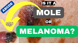 ABCDE of Melanoma Is it a Mole or Melanoma  ABCDE of Skin Cancer  Skin Cancer Symptoms and Signs [upl. by Aseneg]