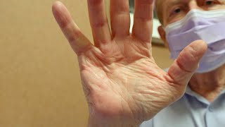 Mayo Clinic Minute  Treating Dupuytren’s contracture without surgery [upl. by Dudden427]