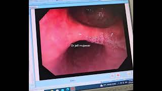 oesophageal diverticulum [upl. by Sirahc]